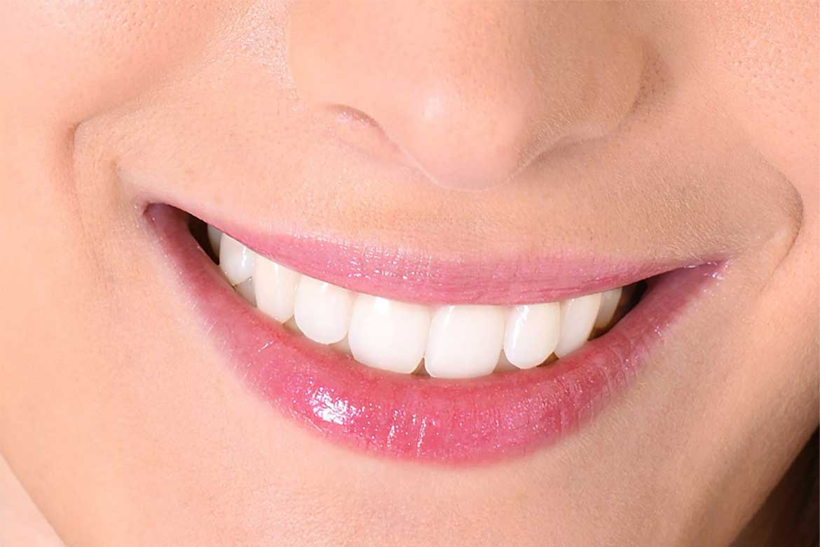The Benefits of Veneers: Transform Your Smile with Dental Veneers