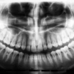 5 Affordable Dental Implants in Bronx You Need to Know About