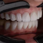 The Ultimate Guide to Crowns for Teeth: What You Need to Know